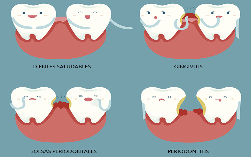 comer galope fecha límite Periodontitis, qué es y cuál es su tratamiento - DentalSuite