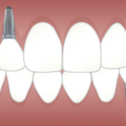 4 Motivos Para Recurrir A Los Implantes Dentales Al Perder Un Diente