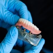Síntomas de rechazo implante dental en Pinto,Madrid